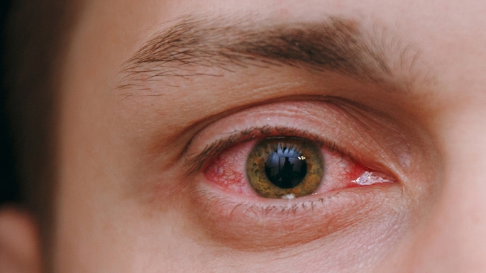 A Quick Guide to Pink Eye